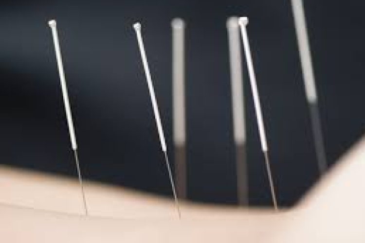 40 évig élt egy akupunktúrás tűvel a gyomrában