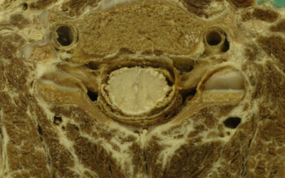 Gerincvelőből diagnosztizálható a szklerózis multiplex