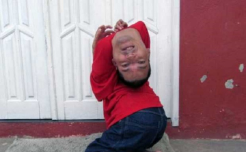 Hihetetlen! Fordítva nőtt a nyakára a férfi feje (videó) 