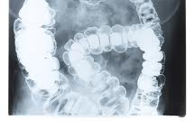 Új kezelés segíthet a Chron-betegségben szenvedőkön